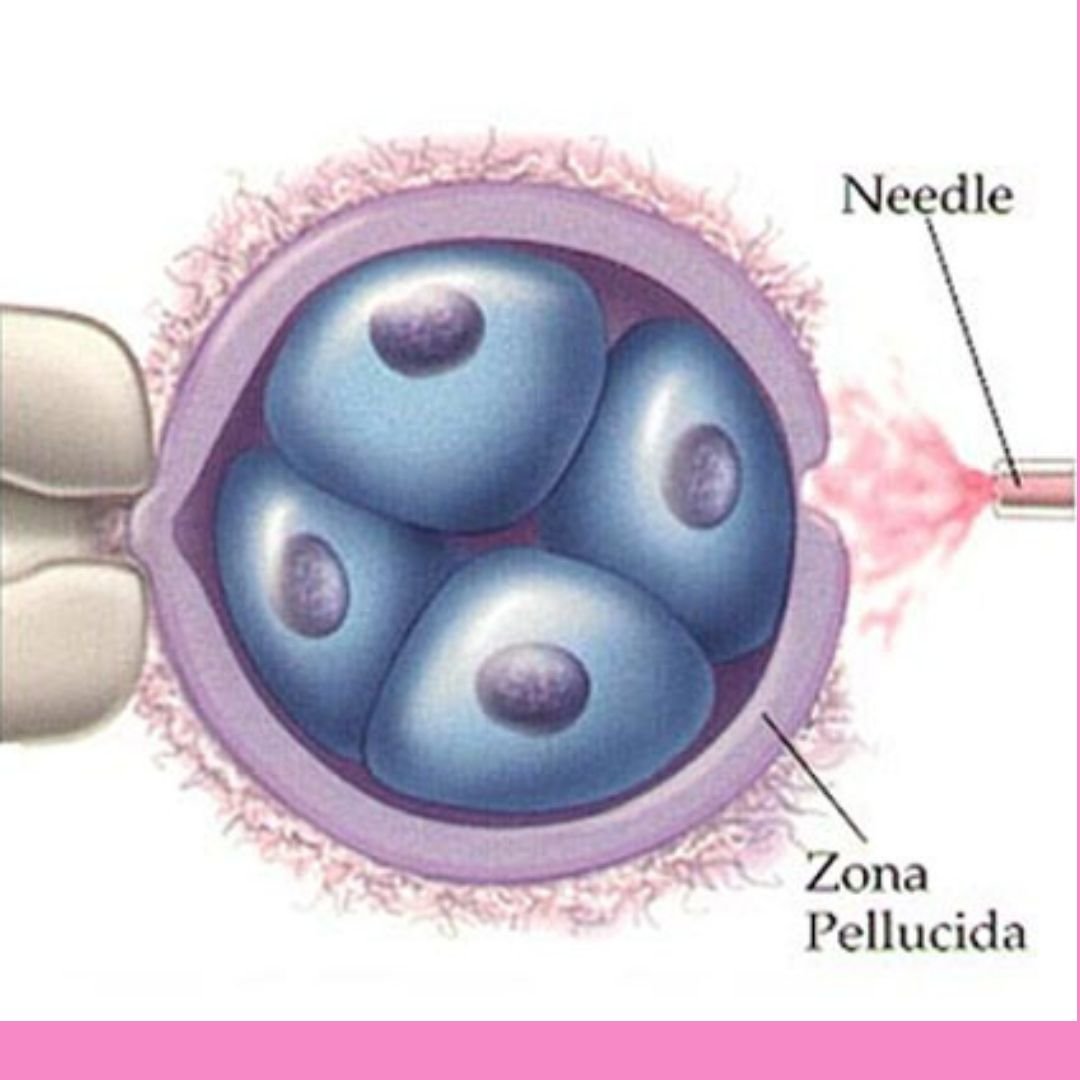Laser assisted hatching in tirupati